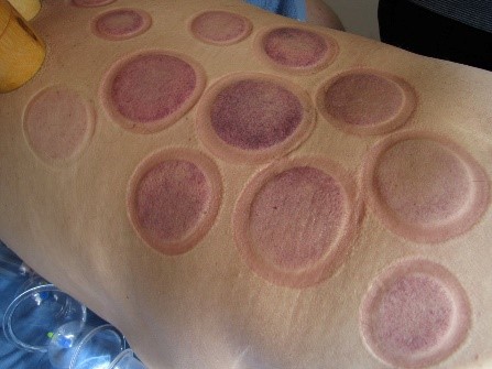 effect of cupping