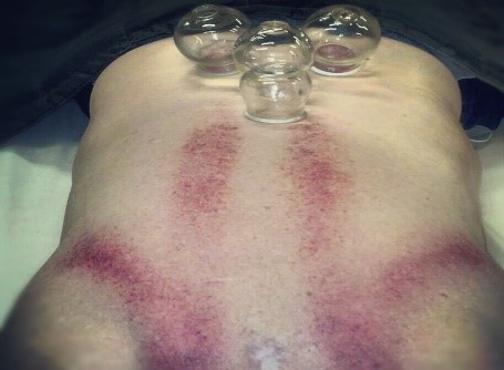 effect of sliding cupping